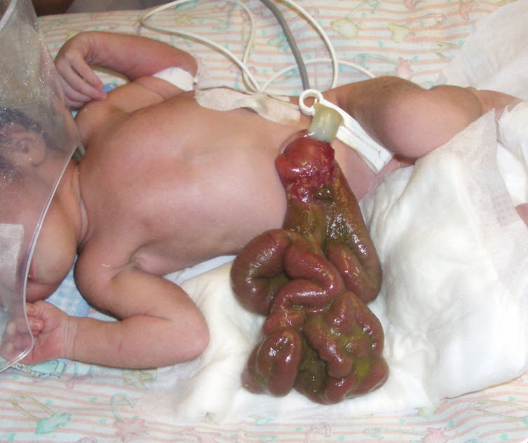Gastrosquisis con inflamación intestinal moderada