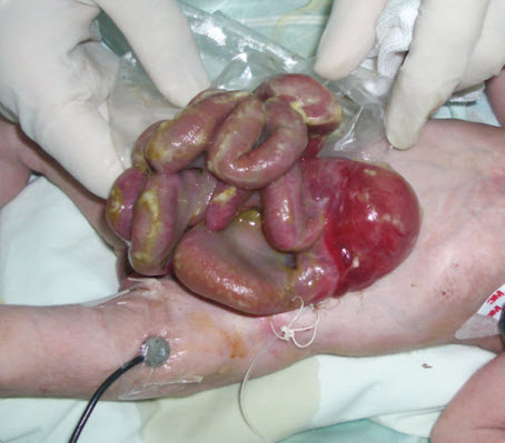 Gastrosquisis con inflamación intestinal severa