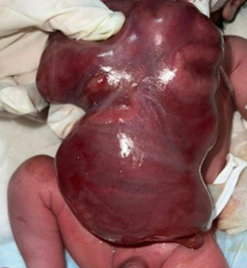 Gastrosquisis con pseudocápsula intestinal