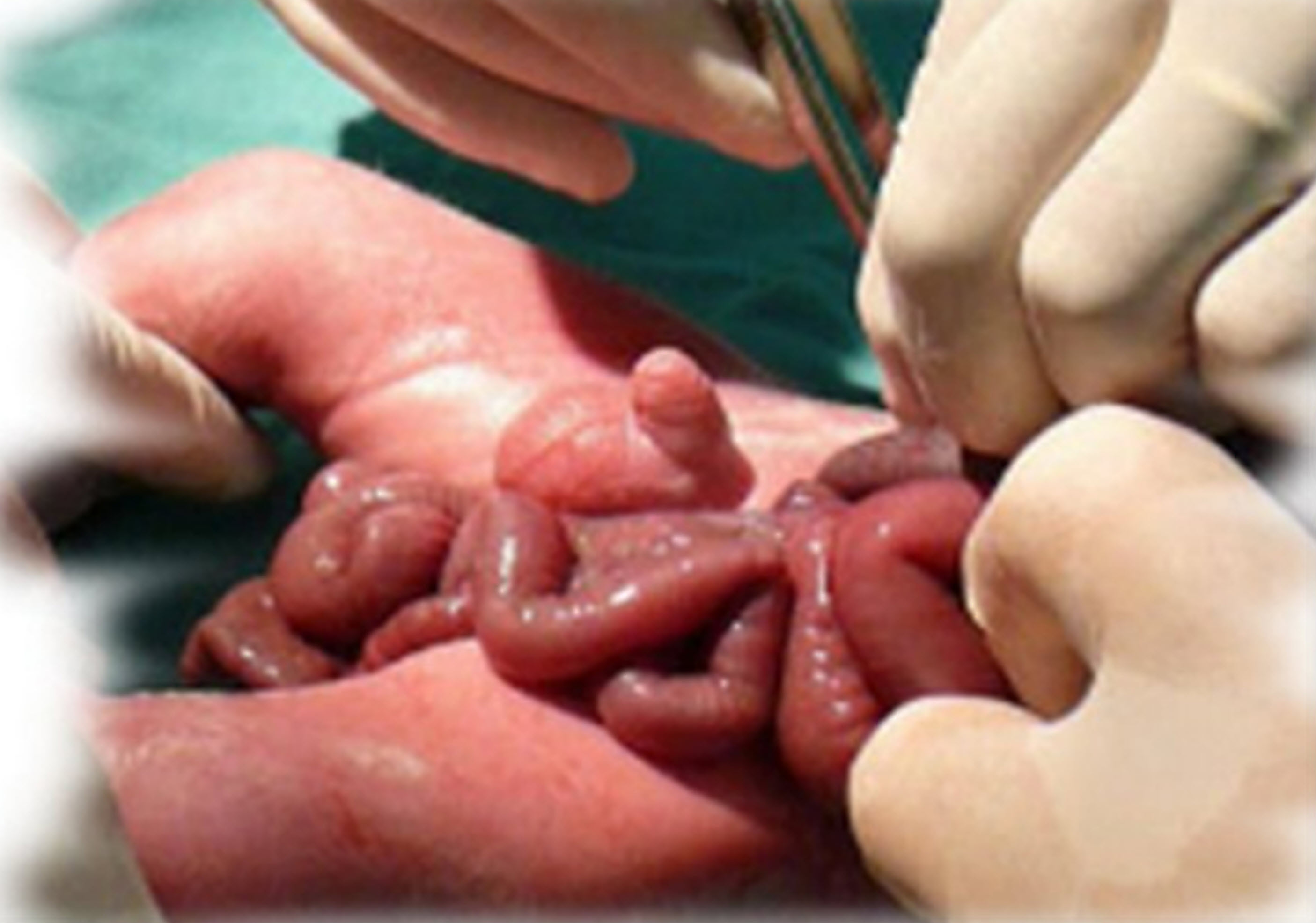 Gastrosquisis con intestino sin inflamación severa